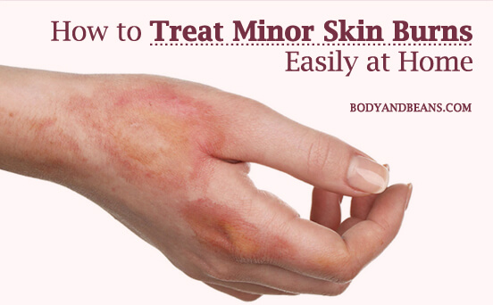 How to Treat Minor Skin Burns Easily at Home