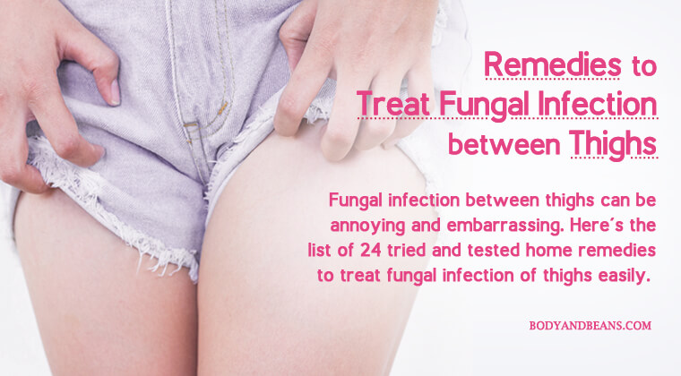 24 Remedies to Treat Fungal Infection between Thighs (Jock Itch Treatment)