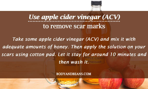 Use apple cider vinegar (ACV) to remove scar marks