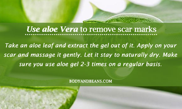 Use aloe Vera to remove scar marks
