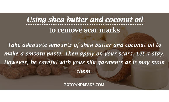 Using shea butter and coconut oil to remove scar marks