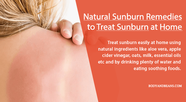 Natural sunburn remedies to treat sunburn easily at home